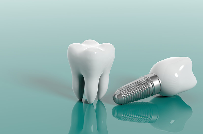 歯の欠損部分に人工歯根を埋入して回復させます