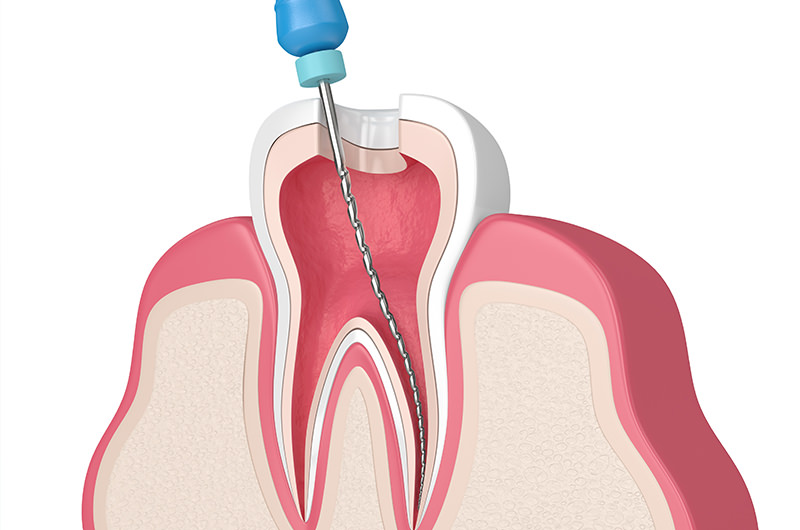 根管内を洗浄・消毒・充填する「根管治療」が必要になることも